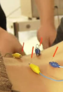 かがやき鍼灸整骨院のパルス治療